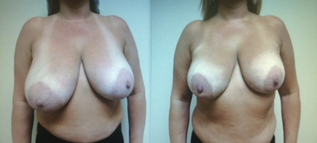 External Ultrasound Assisted Liposuction AND MPX SMART LIPO BREASTS